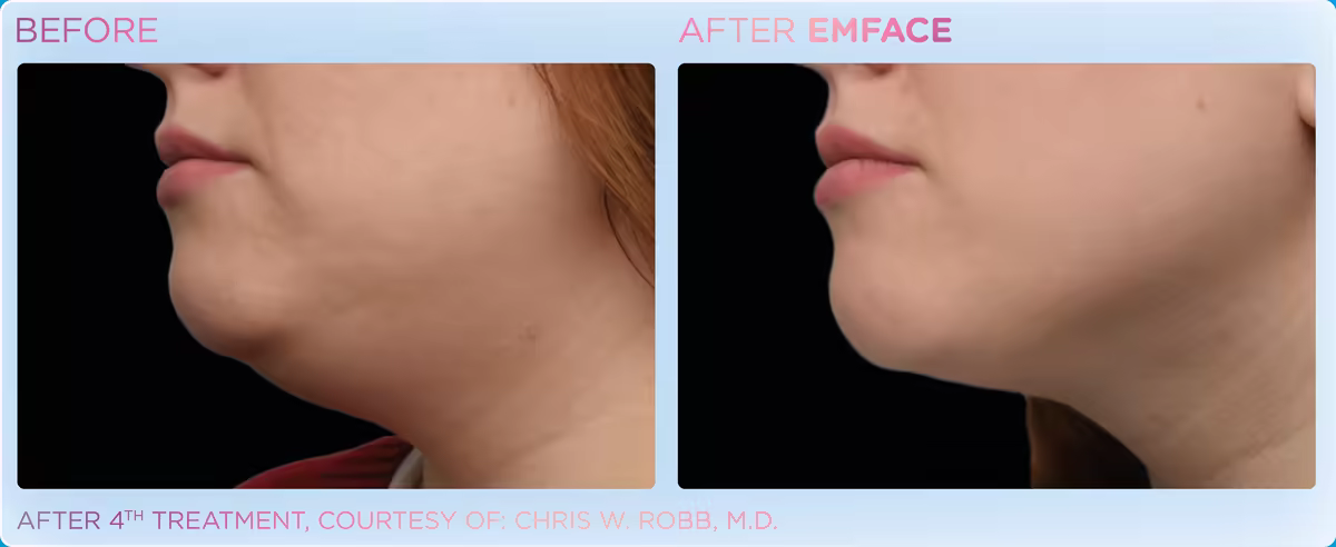 Before and after Emface under the chin, woman, manufacturer photo