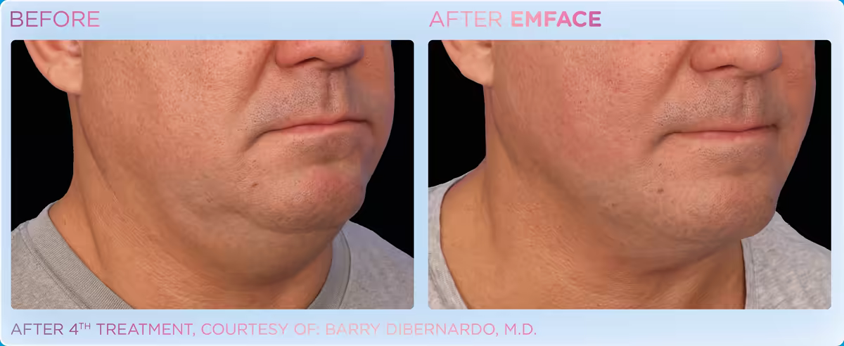 Before and after Emface under the chin, man, manufacturer photo