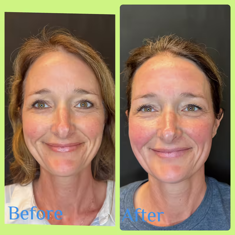Before and after Emface, front view