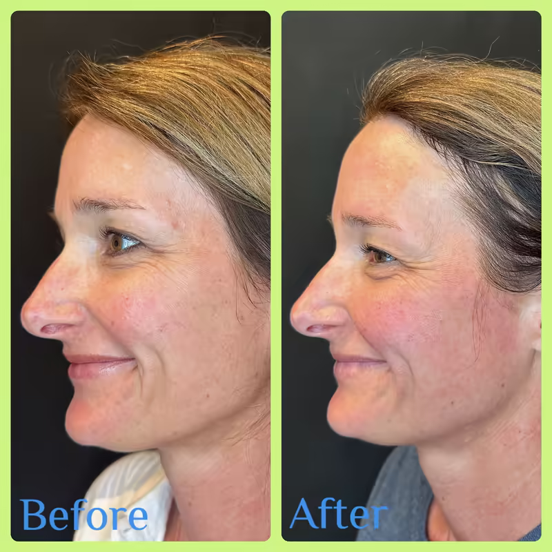Before and after Emface, side view