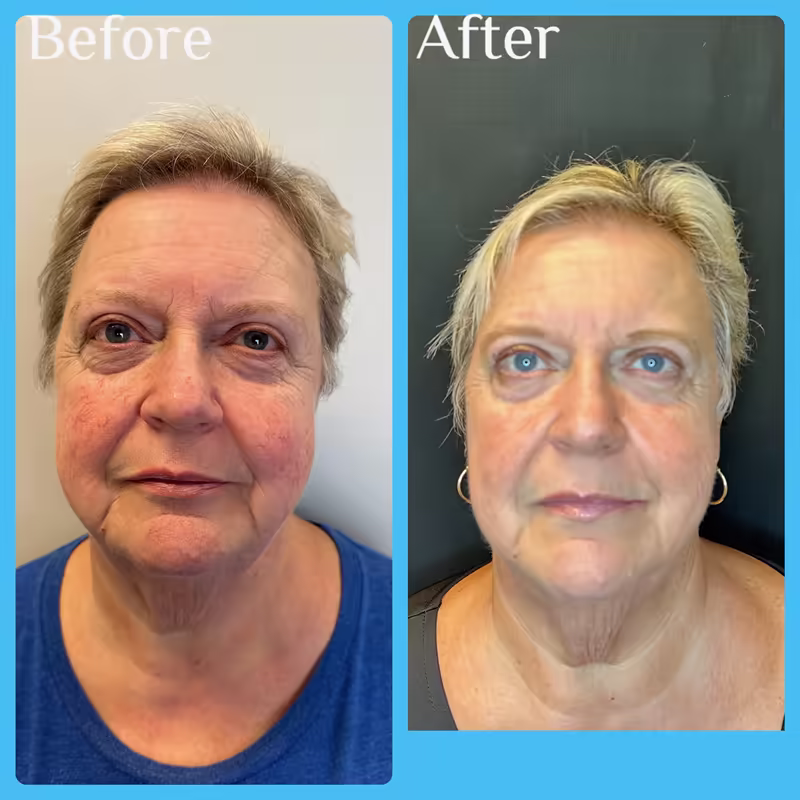Before and after Emface, front view