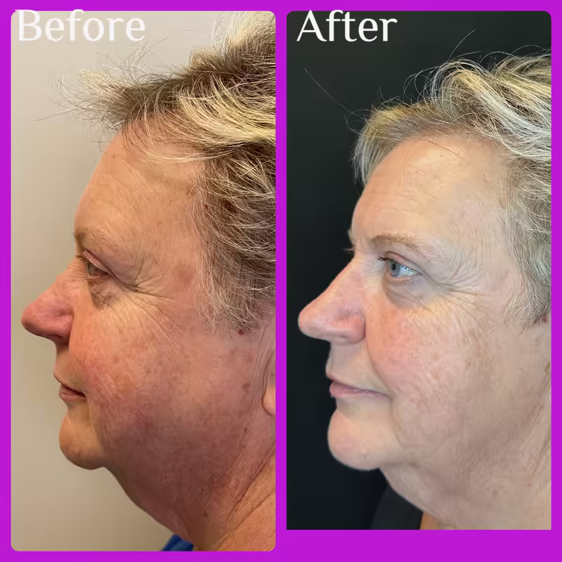 Before and after Emface, side view