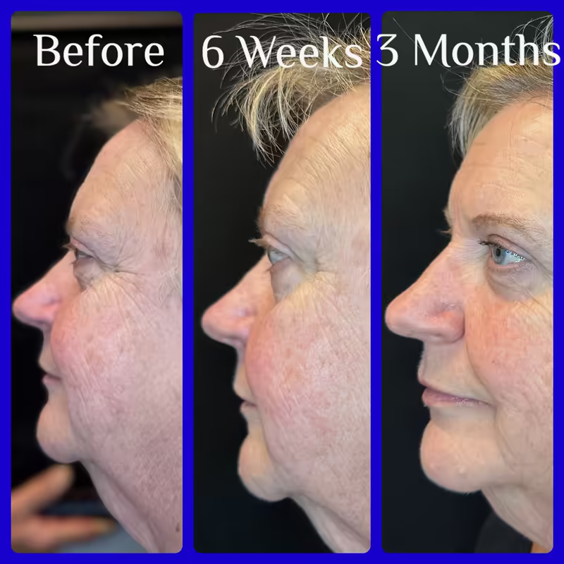 Patient before Emface, at 6 weeks, and at 3 months