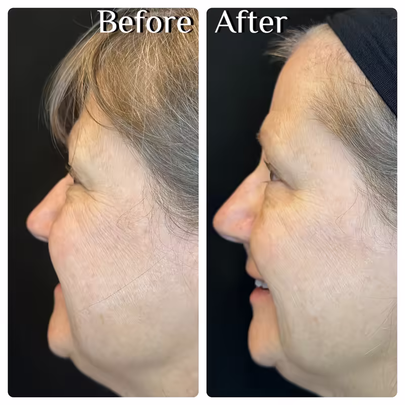 Before and after Emface, side view