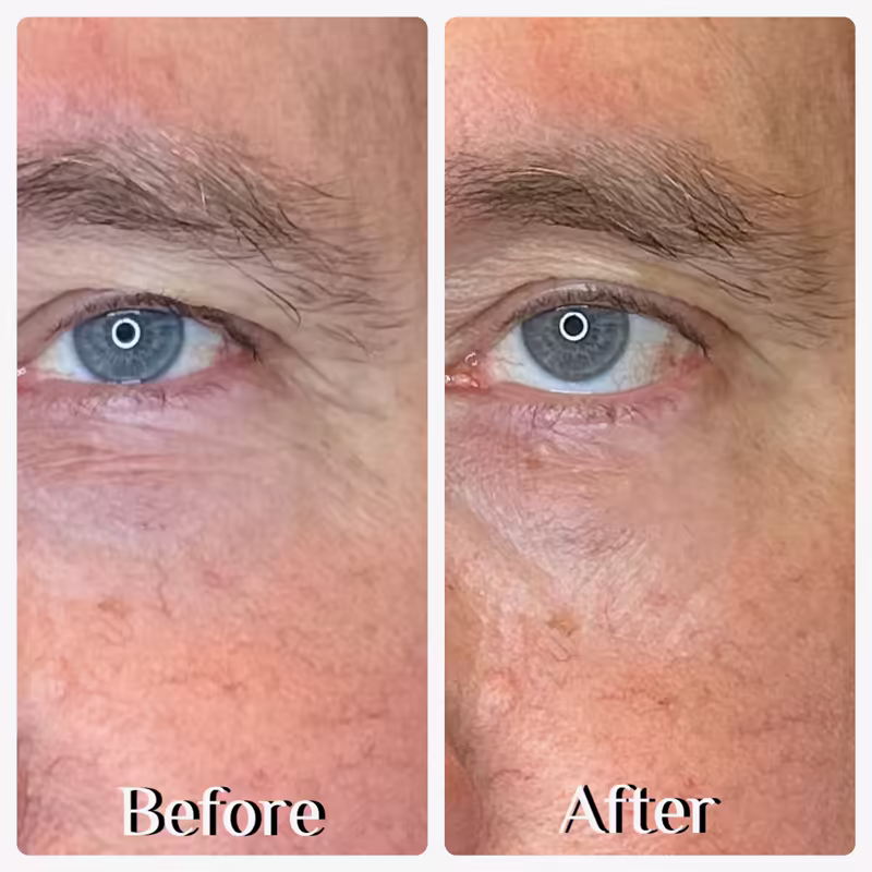Crow's feet and eyebrow before and one week after Emface