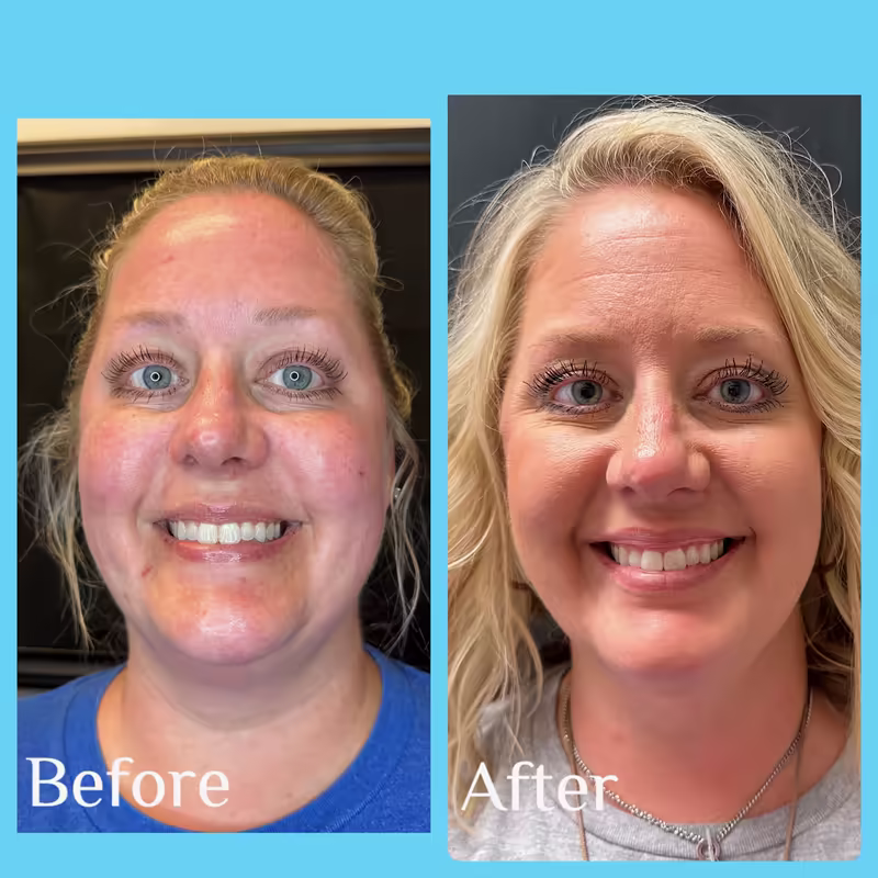 Before and after Emface, front view