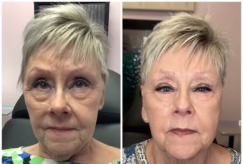Before and after Emface, front view